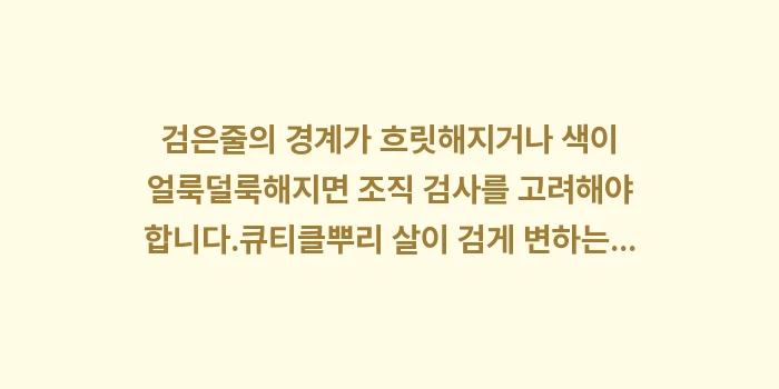손톱 검은줄 흑색종 증상: ✔검은줄의 경계가 흐릿해지거... (1)